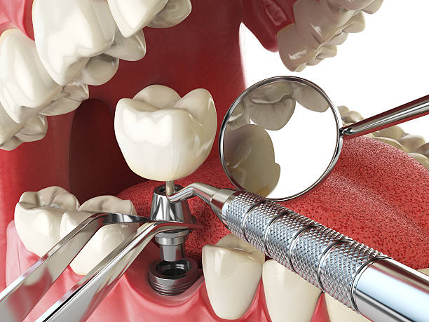Best Emergency Tooth Extraction in Shannon, GA